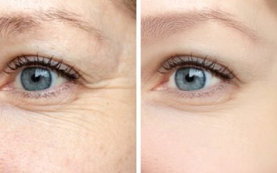 Woman face, eye wrinkles before and after treatment - the result of rejuvenating cosmetological procedures of biorevitalization, botox and pigment spots removal.