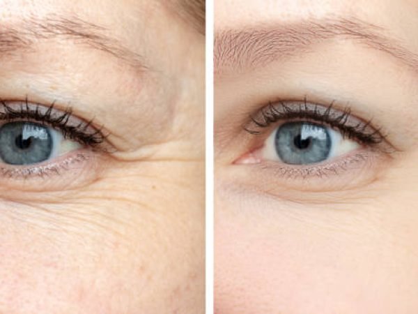 Woman face, eye wrinkles before and after treatment - the result of rejuvenating cosmetological procedures of biorevitalization, botox and pigment spots removal.