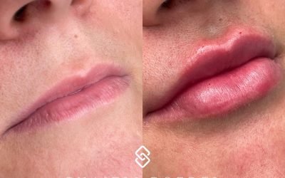 preenchimento-labial-CHRZazF4