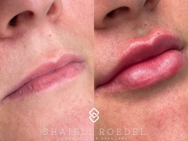 preenchimento-labial-CHRZazF4